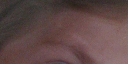 Гемангиома. Кто сталкивался и как лечили? - IMG_1401.JPG