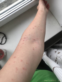 Это только начало, через день все стало гораздо хуже