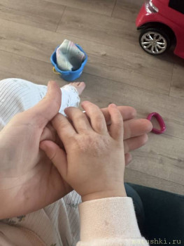 Подскажите срочно Ожог  - IMG_0784.jpeg