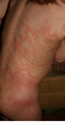 Диатез - IMG_0187-1.jpg